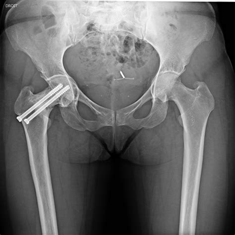 Normal hip xray femoral neck fracture xray - fertbud