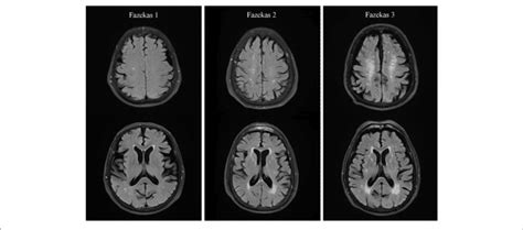 Representative T2 Flair Images Illustrating Fazekas Score Download Scientific Diagram
