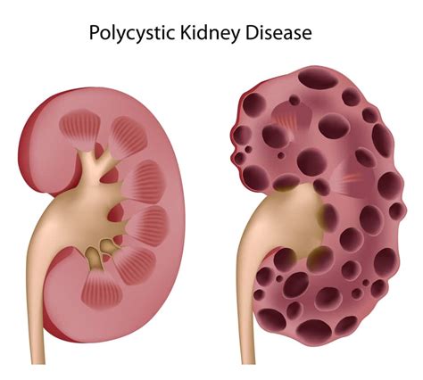 Kidney Cysts Kidney Cancer Specialists In Nyc