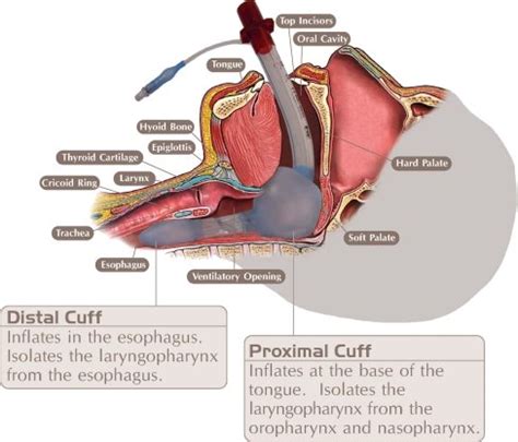 King Tube Airway