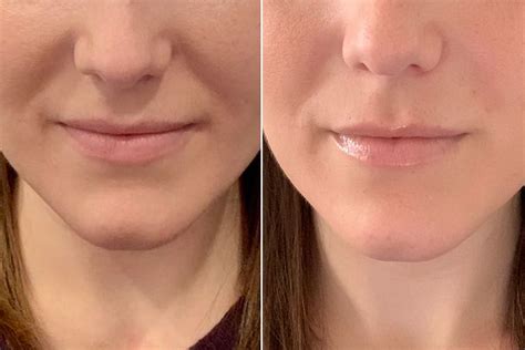 Sensational Tips About How To Get Rid Of Nasolabial Folds Policebaby