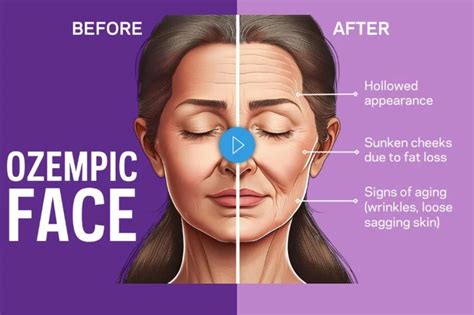 Cabeça De Ozempic Antes E Depois - Ozempic Face: Prevenir efectos secundarios del adelgazamiento rápido