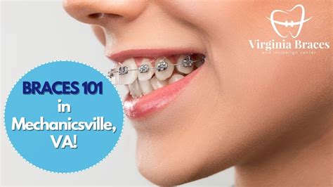 Braces 101 — Virginia Braces