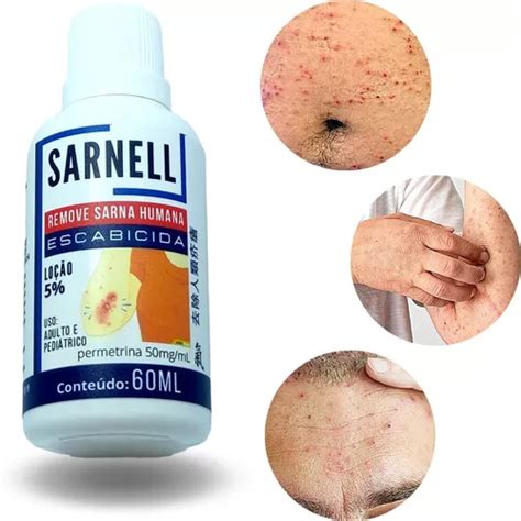 O Que Tomar Para Sarna Humana - Pomada Creme Loção Para Sarna Escabiose Coceira Sarna Humana | MercadoLivre