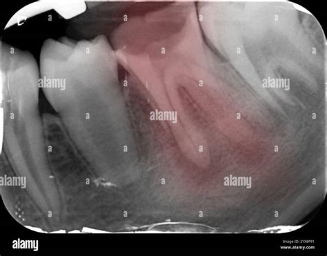 coloured periapical  ray   mandibular left  molar tooth