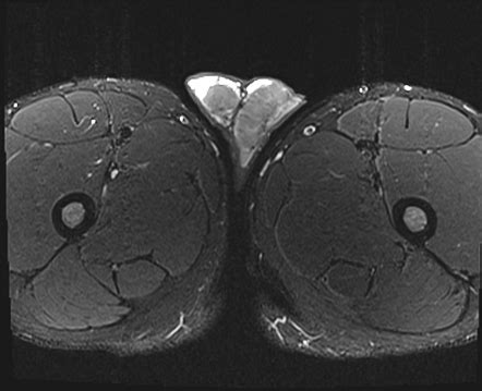 Testicular Adrenal Rests Radiology Reference Article Radiopaedia Org