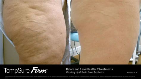 Cellulite Treatment Tempsure Firm - Chicago Aesthetics