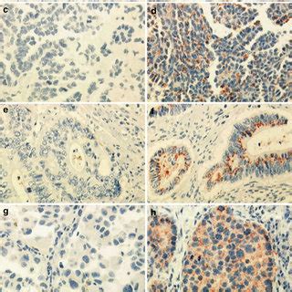 traf  overexpressed  amplified  human cancers traf