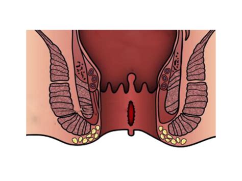 Anal Fissure Treatment Theanusandrectumclinic