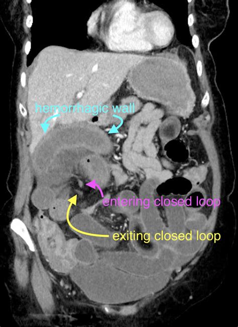 File:Closed loop small bowel obstruction due to adhesive band, with ...