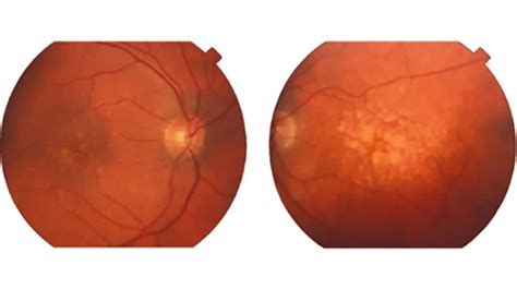 Macular Degeneration Drusen