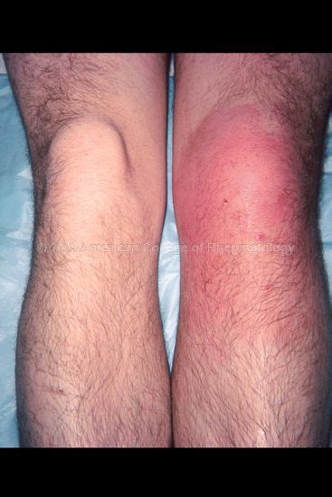 Rheumatology Image Bank Septic Prepatellar Bursa Arthritis