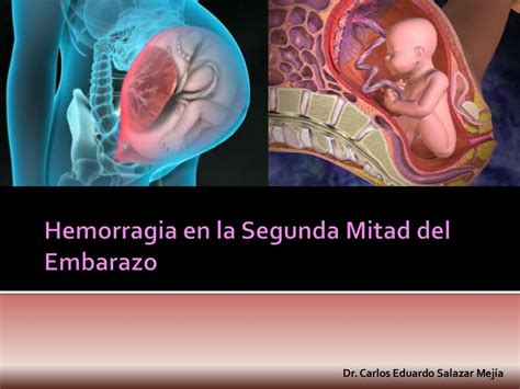 Hemorragias En La Segunda Mitad Del Embarazo By Eduardo Salazar Via