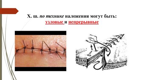 Швы хирургические - презентация онлайн