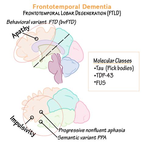 Pathology Glossary: Frontotemporal Dementia | Draw It to Know It