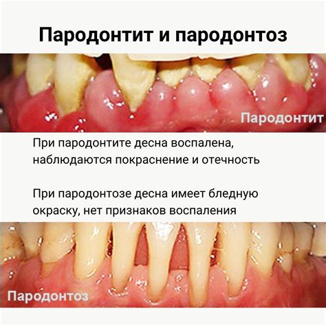 Лечение пародонтита десен лазером в домашних условиях | РИКТА