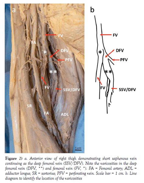 Great Saphenous Vein Anatomy