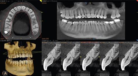 Surgical Guides Digicad Dental Studio