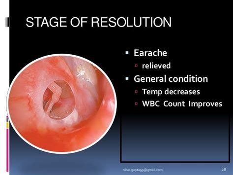 Acute Otitis Media