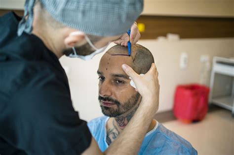 Les Greffes De Cheveux Pour Lutter Contre La Calvitie