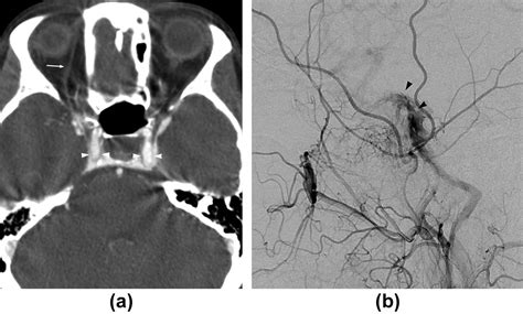 Multidetector Ct Angiography In The Diagnosis And Classification Of