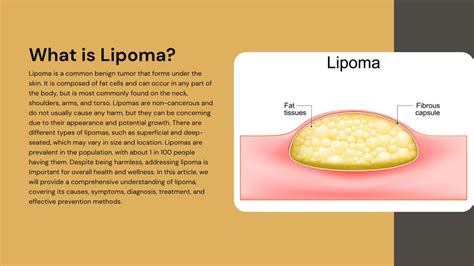 Ppt Lipoma Causes Symptoms And Effective Prevention Methods