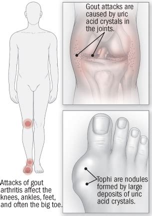 gout | Expert In Feet Dr. Daniel Drapacz