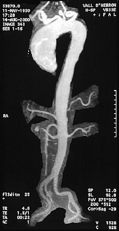 Parasagital Oblique Mpr Image Of A Mdct Aortography Showing An Download Scientific Diagram