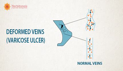 Non-healing Varicose Ulcer treatment in ayurveda