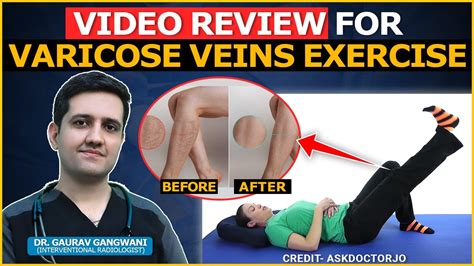 Yoga Exercises For Varicose Veins Review And Commentary On Experts