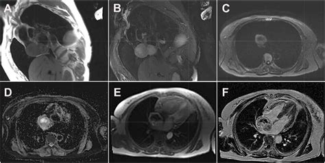 Cardiac Magnetic Resonance Images Of Cardiac Paraganglioma A