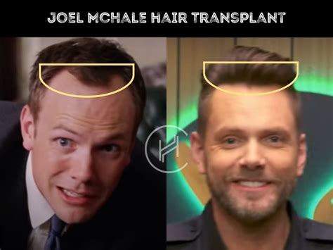 Joel McHale Hair Transplant - Hair Loss & Technical Analysis