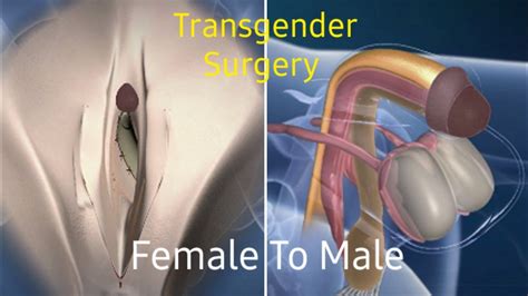 Transgender Surgery Sex Change Sex Reassignment Female To Male