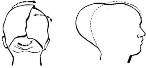newborn skull shape