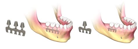 Dental Implant Types