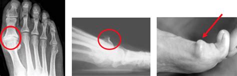 Hallux Rigidus Orthopedie Team
