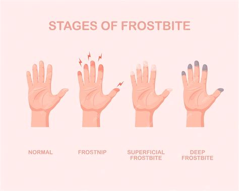 premium vector frozen hands  fingers stage  frostbite skin
