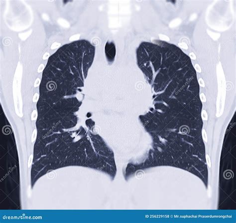 Ct Chest Coronal Mip View Royalty Free Stock Image
