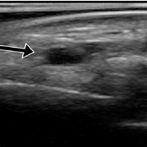 A Ultrasound Of The Radial Artery Showing Normal Anatomy Arrow Download Scientific Diagram