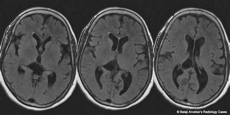 Dr Balaji Anvekar FRCR: Ependymal cyst MRI