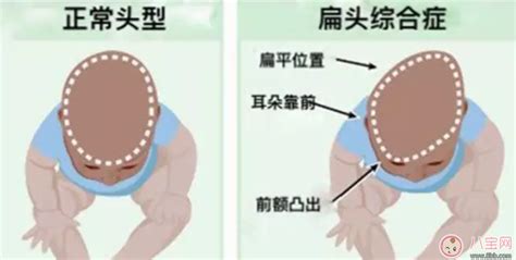 宝宝的头睡扁了怎么办 如何矫正成圆头 八宝网