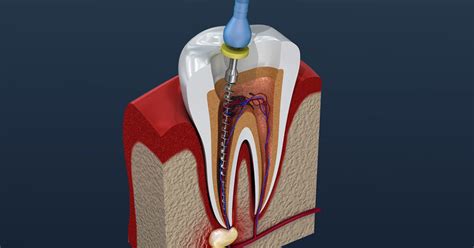 Root End Procedures Can Save Teeth My Dentist Toluca Lake