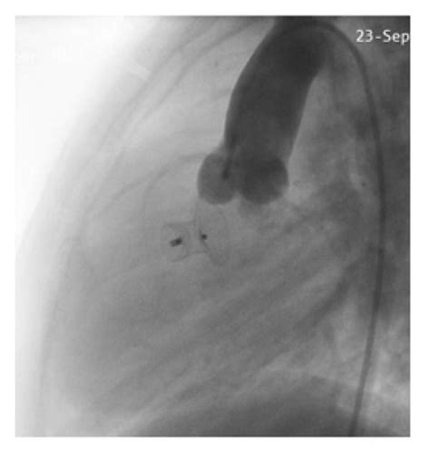 A Cross Sectional Echocardiogram In The Long Axis Parasternal View Of