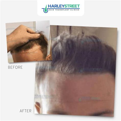 Hair Transplant For A Receding Hairline Harley Street Htc