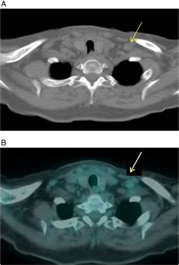 Influence of previous treatment of oral squamous cell carcinoma on the ...