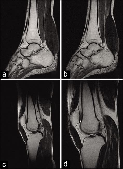 Achilles Tendon Xanthoma