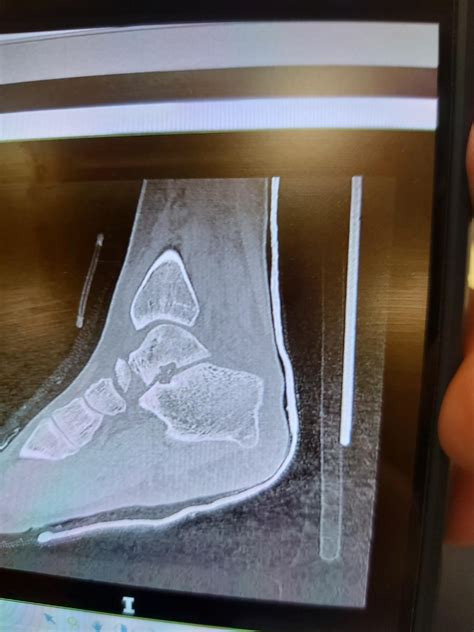 Talus fracture displacement, front part of the talus broke off and