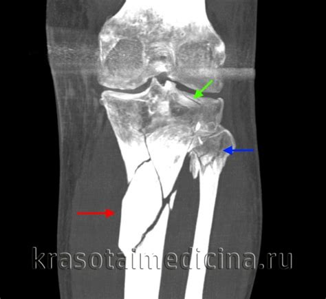 Перелом голени - причины, симптомы, диагностика и лечение