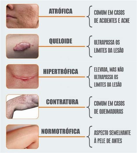 O Que É Cicatriz Hipertrofica - Cicatriz Hipertrofica Antes E Depois