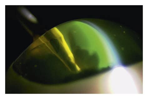 Viscous Dispersive Type Of Ophthalmic Viscosurgical Devices Ovds A
